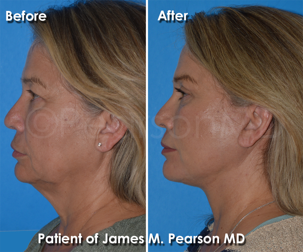 Dr. Pearson Facelift