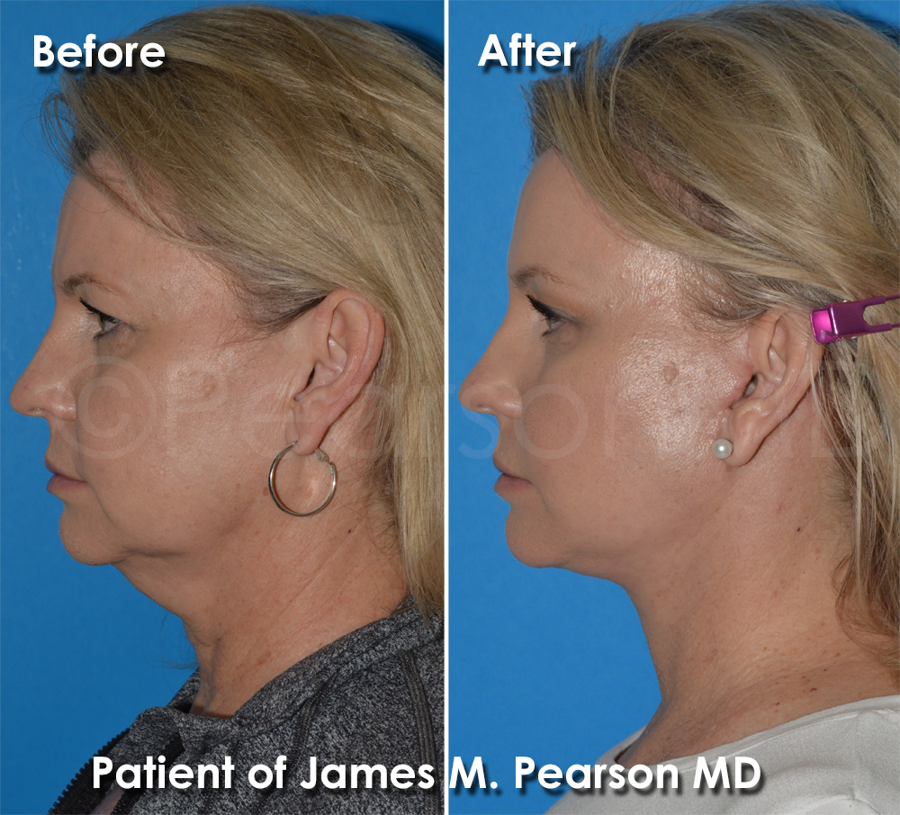 Dr. Pearson Facelift Surgery