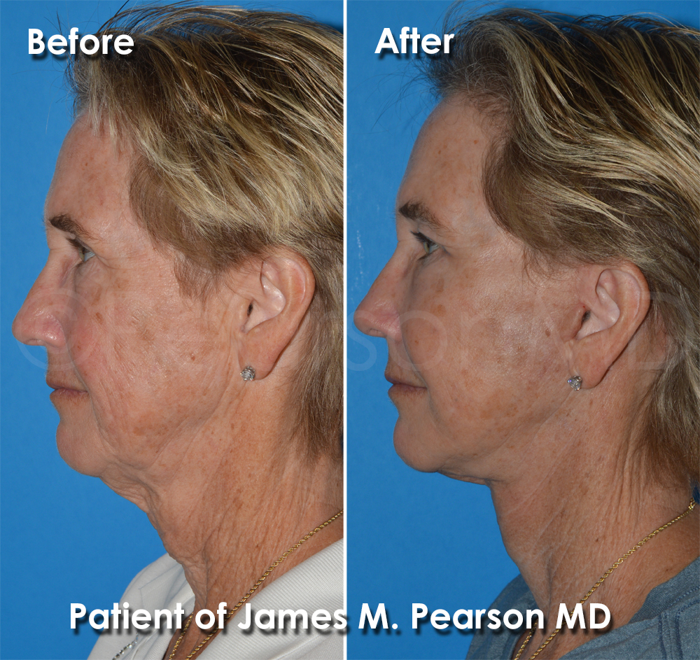Dr. Pearson Facelift