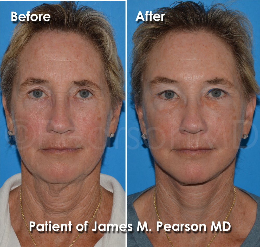 Pearson Plastic Surgery