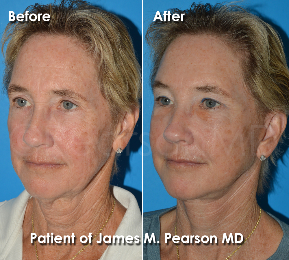 Dr. Pearson Facelift Surgery