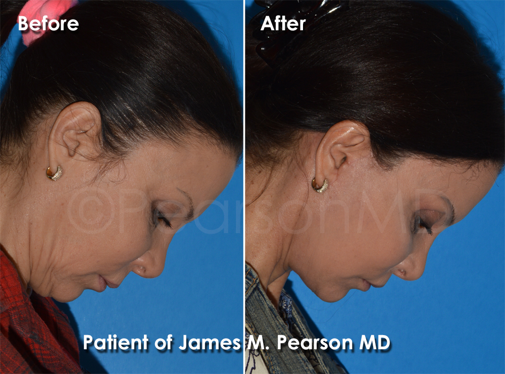 Pearson Plastic Surgery