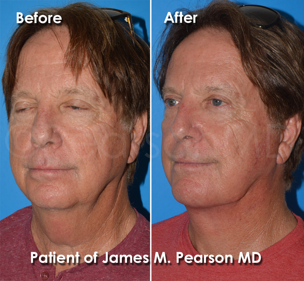 Dr. Pearson Facelift Surgery