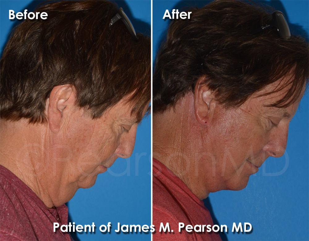 Pearson Plastic Surgery