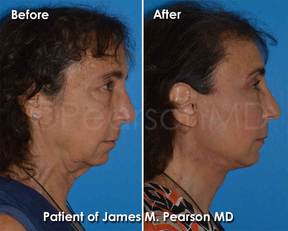 Pearson Plastic Surgery