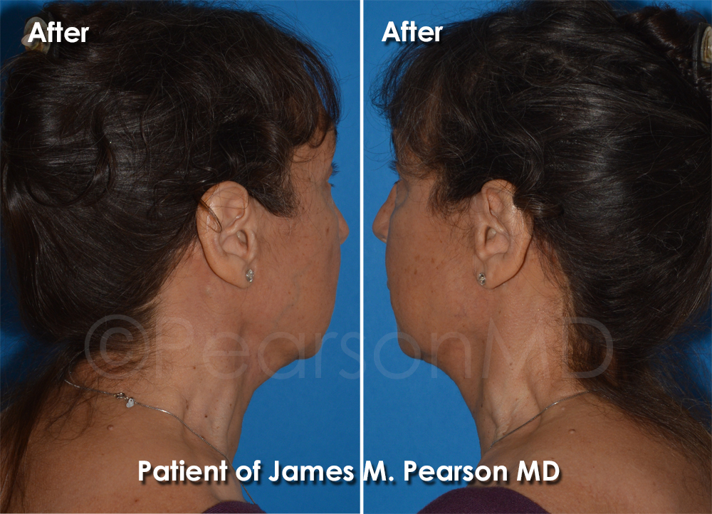Dr. Pearson Facelift Surgery