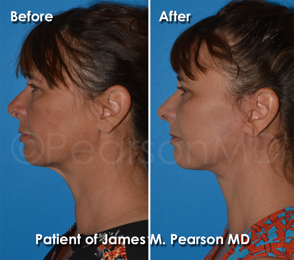 Dr. Pearson Facelift