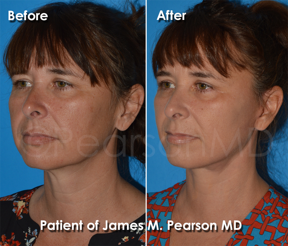 Dr. Pearson Facelift Surgery