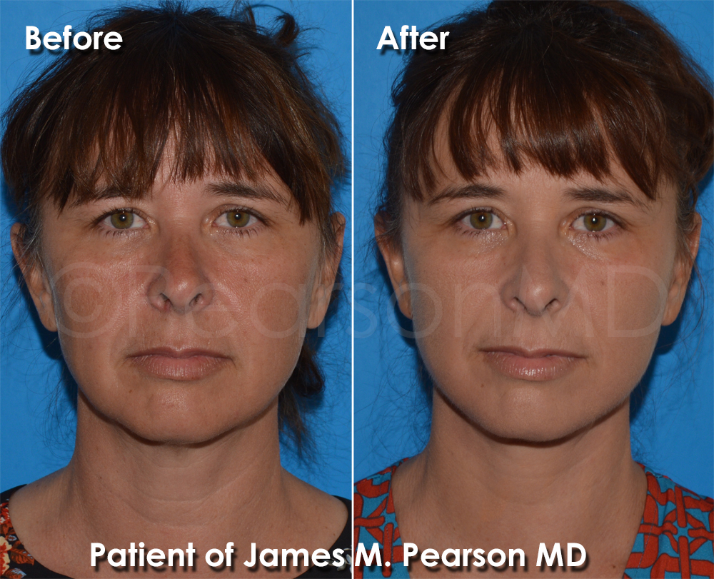 Dr. Pearson Facelift Surgery