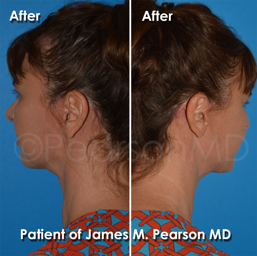Dr. Pearson Facelift Surgery