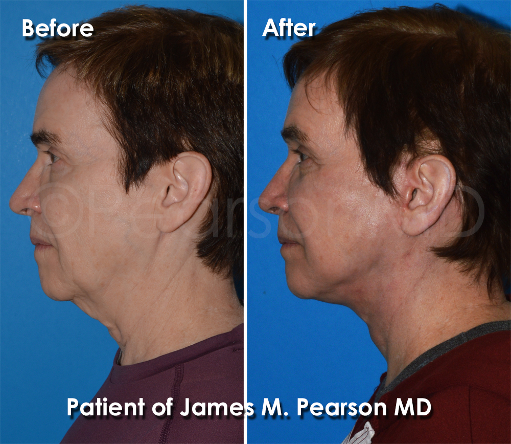 Dr. Pearson Facelift