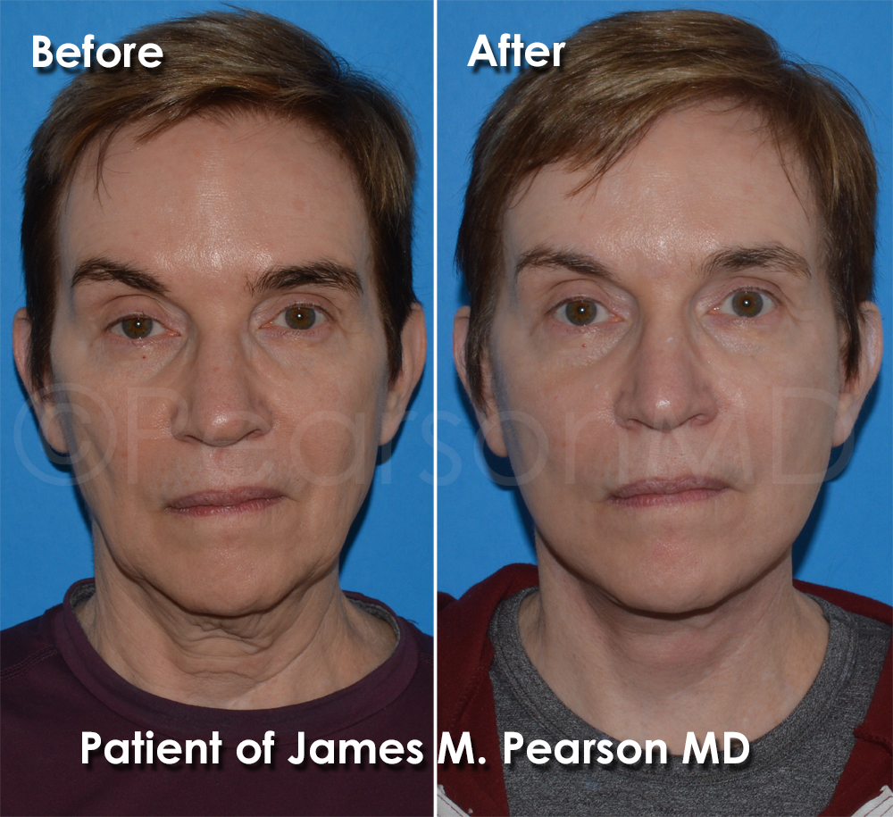 Pearson Plastic Surgery