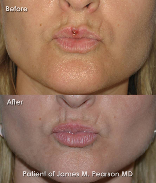 Photo Lip Reconstructive Surgery
