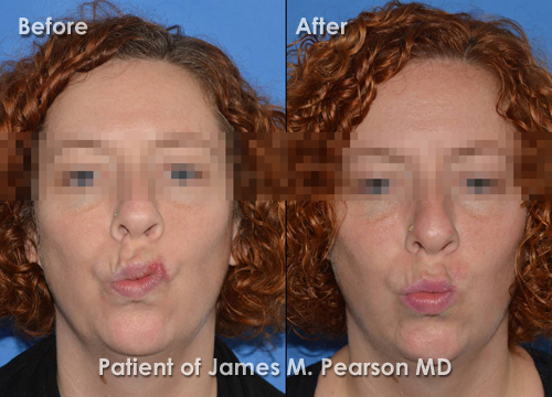 Pearson Reconstructive Surgery