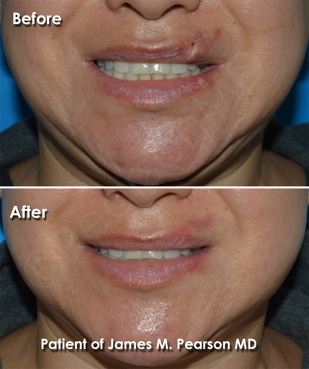 Dr. Pearson Facial Plastic Surgeon