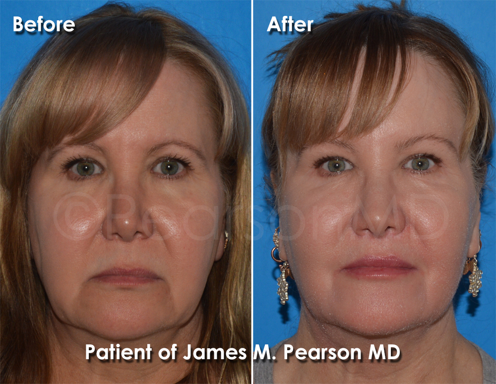 Dr. Pearson Facial Plastic Surgeon