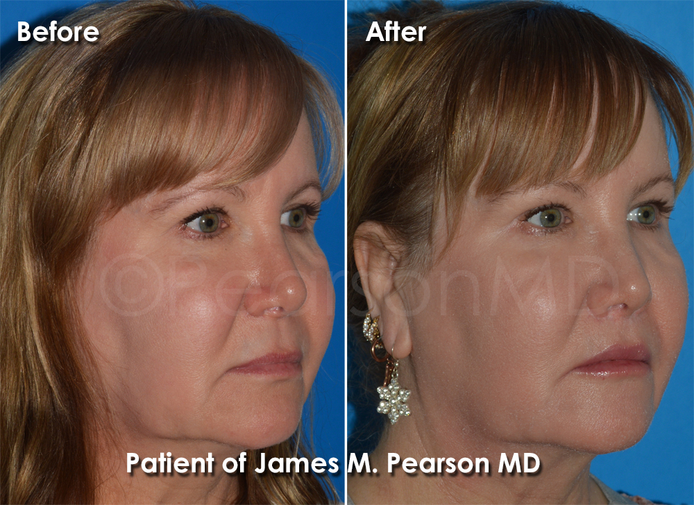 Dr. Pearson Facial Plastic Surgeon