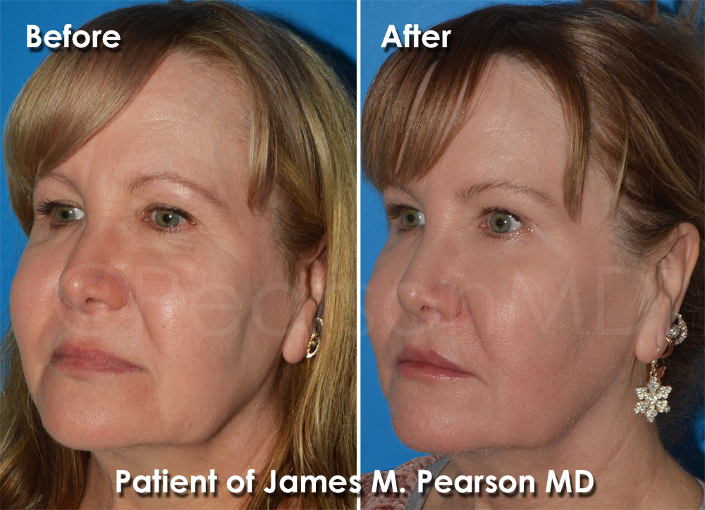 Dr. Pearson Facial Plastic Surgeon