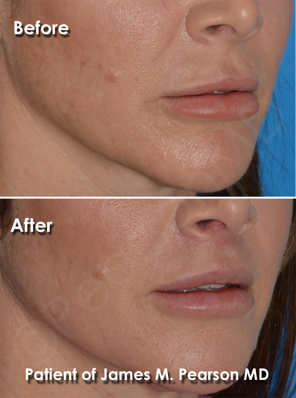 Dr. Pearson Facial Plastic Surgeon
