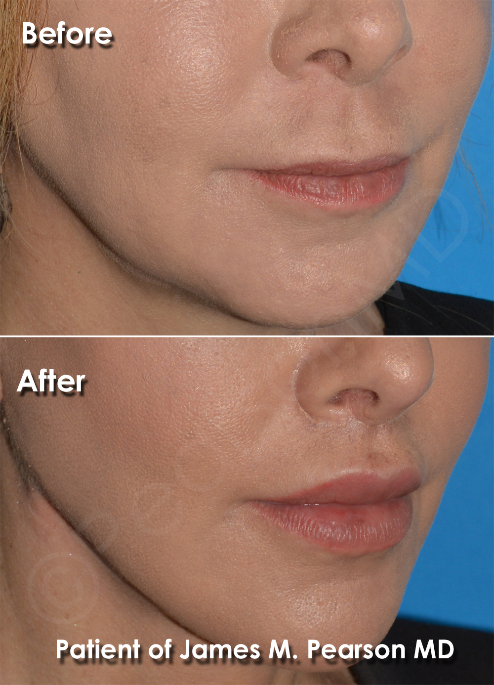Dr. Pearson Facial Plastic Surgeon