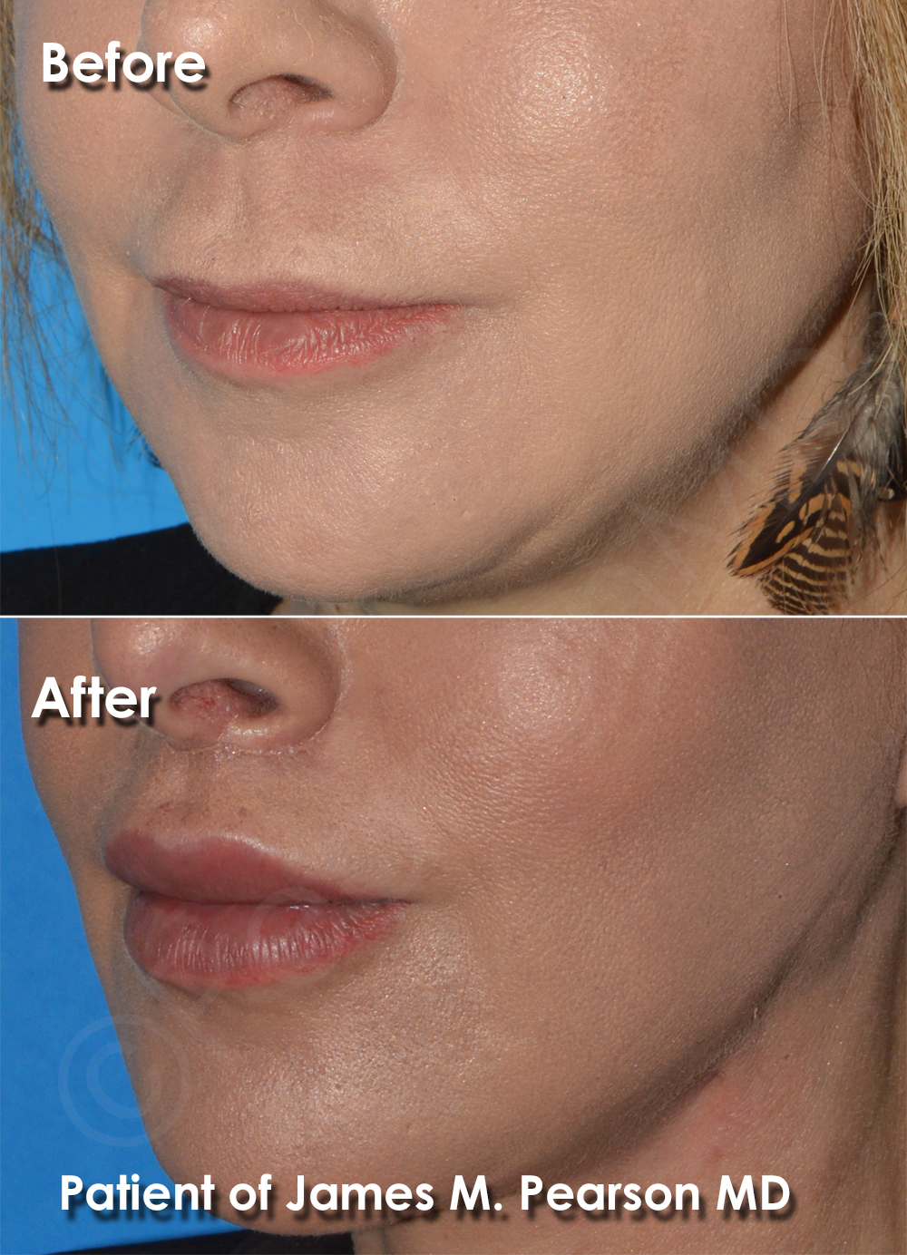 Dr. Pearson Facial Plastic Surgeon