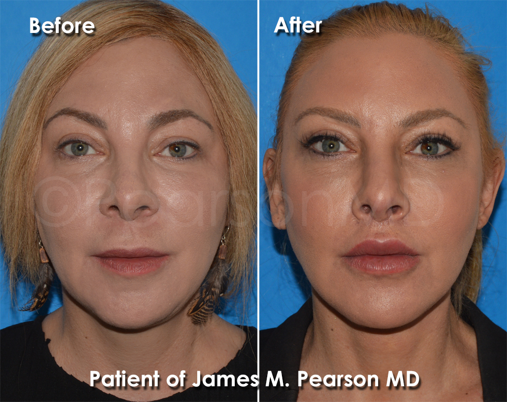 Pearson Plastic Surgery