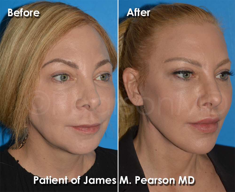 Pearson Plastic Surgery