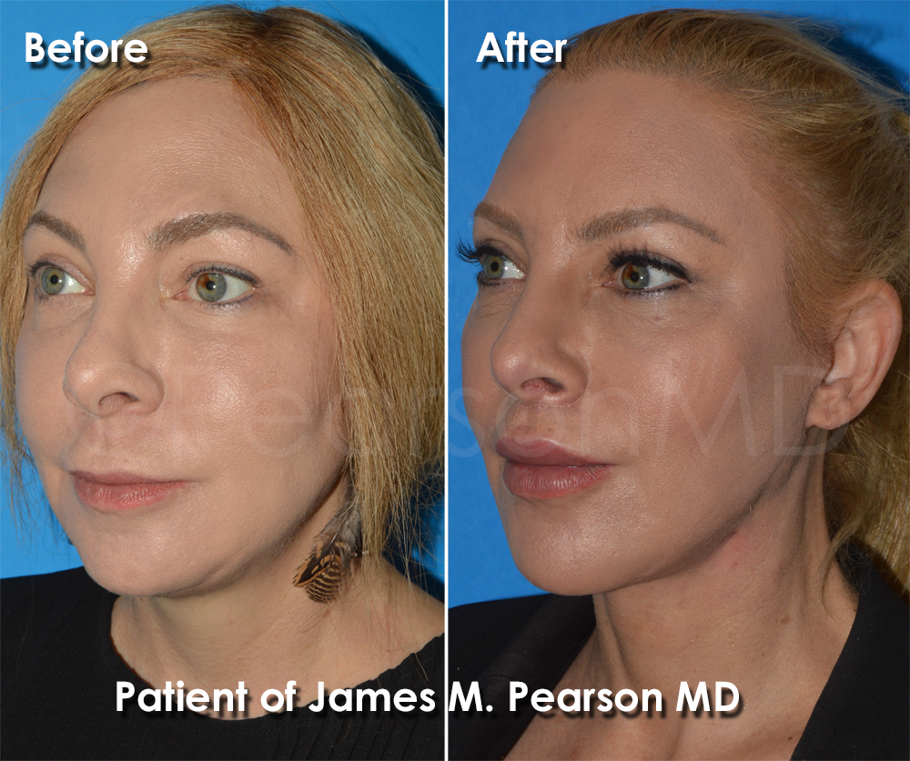 Pearson Plastic Surgery