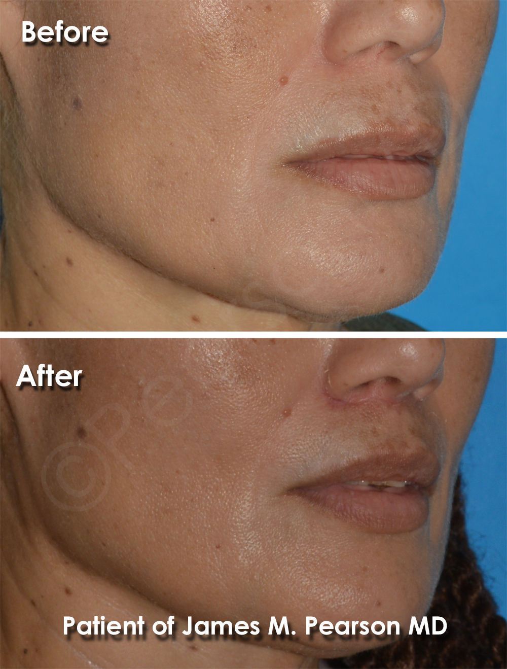 Dr. Pearson Facial Plastic Surgeon