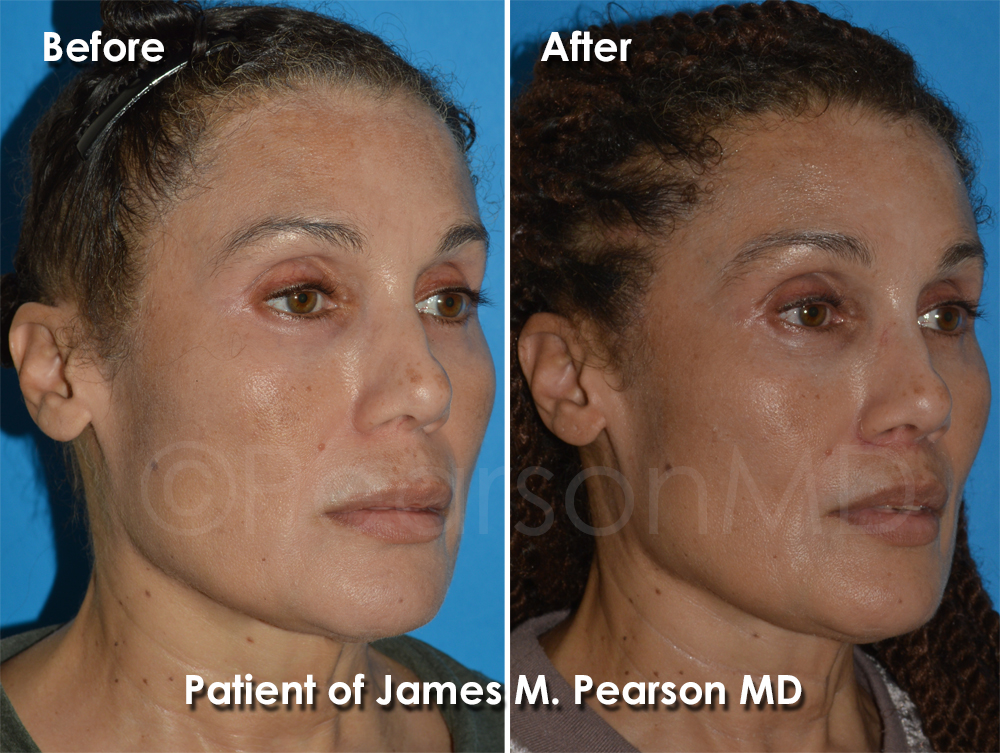 Pearson Plastic Surgery