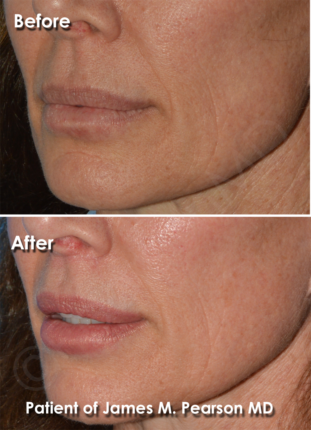 Dr. Pearson Facial Plastic Surgeon