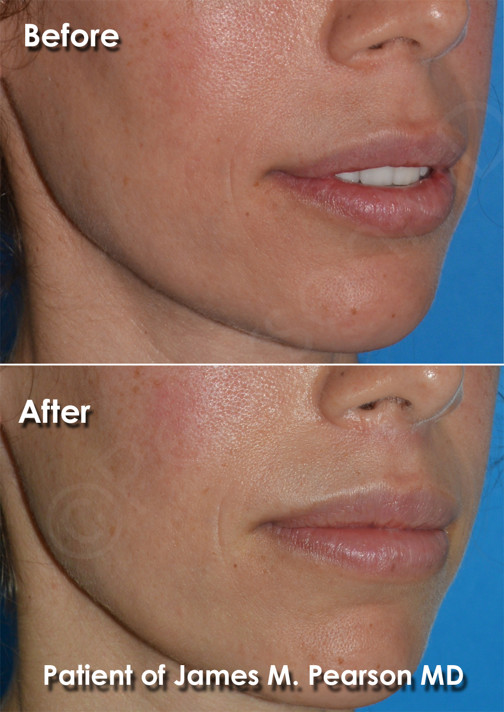 Dr. Pearson Facial Plastic Surgeon