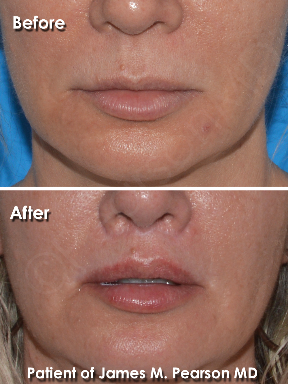 Dr. Pearson Facial Plastic Surgeon