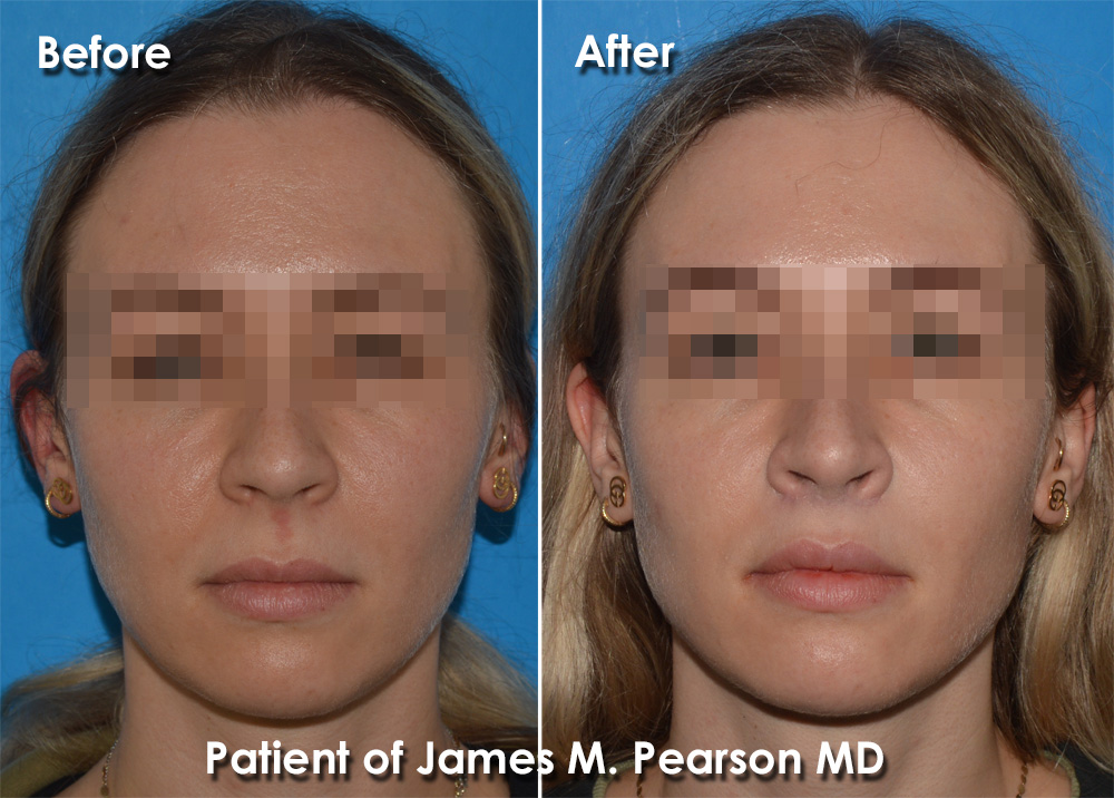 Dr. Pearson Facial Plastic Surgeon
