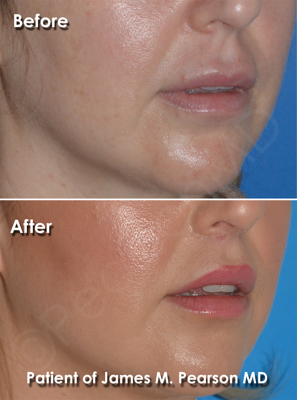 Dr. Pearson Facial Plastic Surgeon