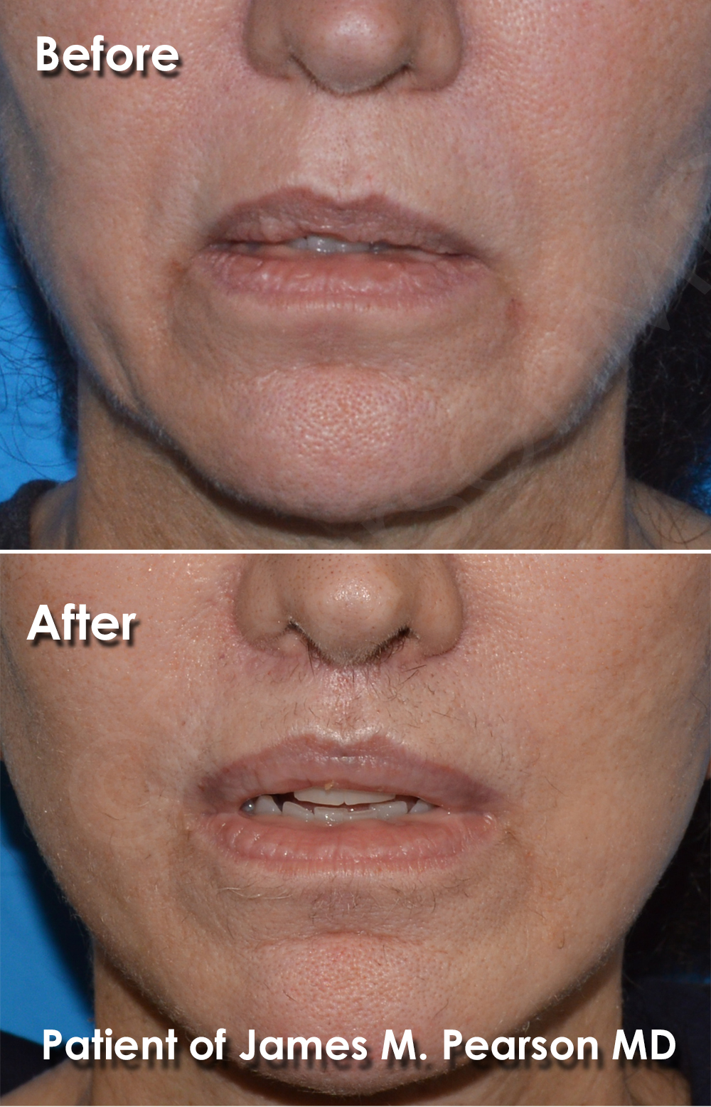 Pearson Plastic Surgery