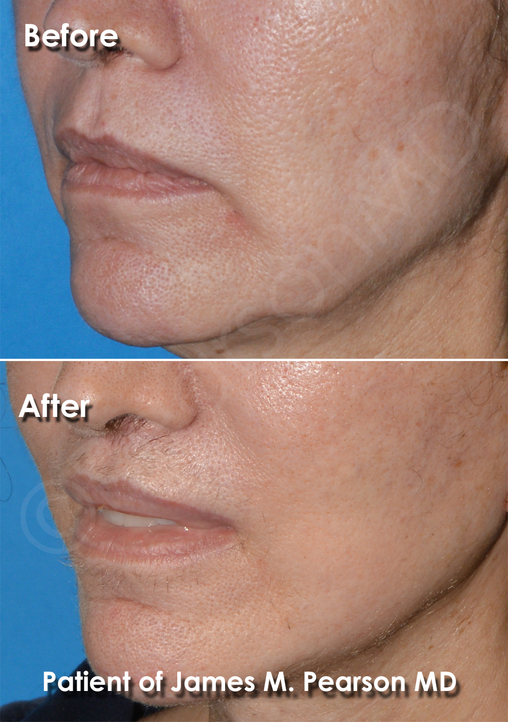 Dr. Pearson Plastic Surgeon