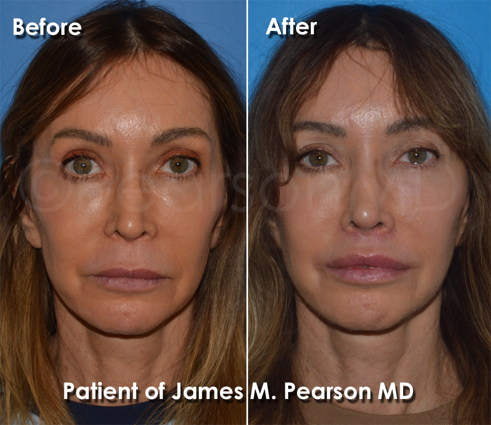 Dr. Pearson Facial Plastic Surgeon