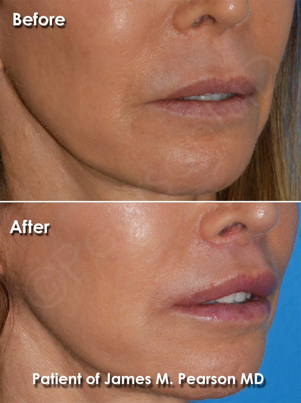 Dr. Pearson Facial Plastic Surgeon