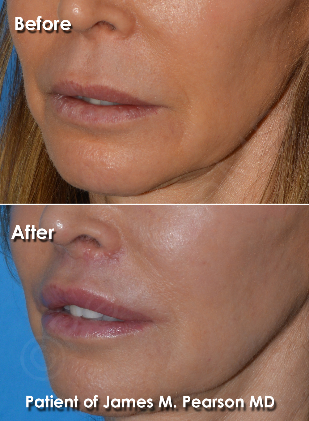 Dr. Pearson Facial Plastic Surgeon
