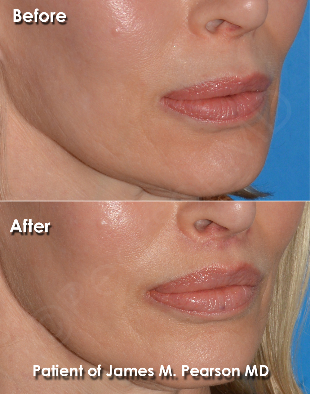 Dr. Pearson Facial Plastic Surgeon