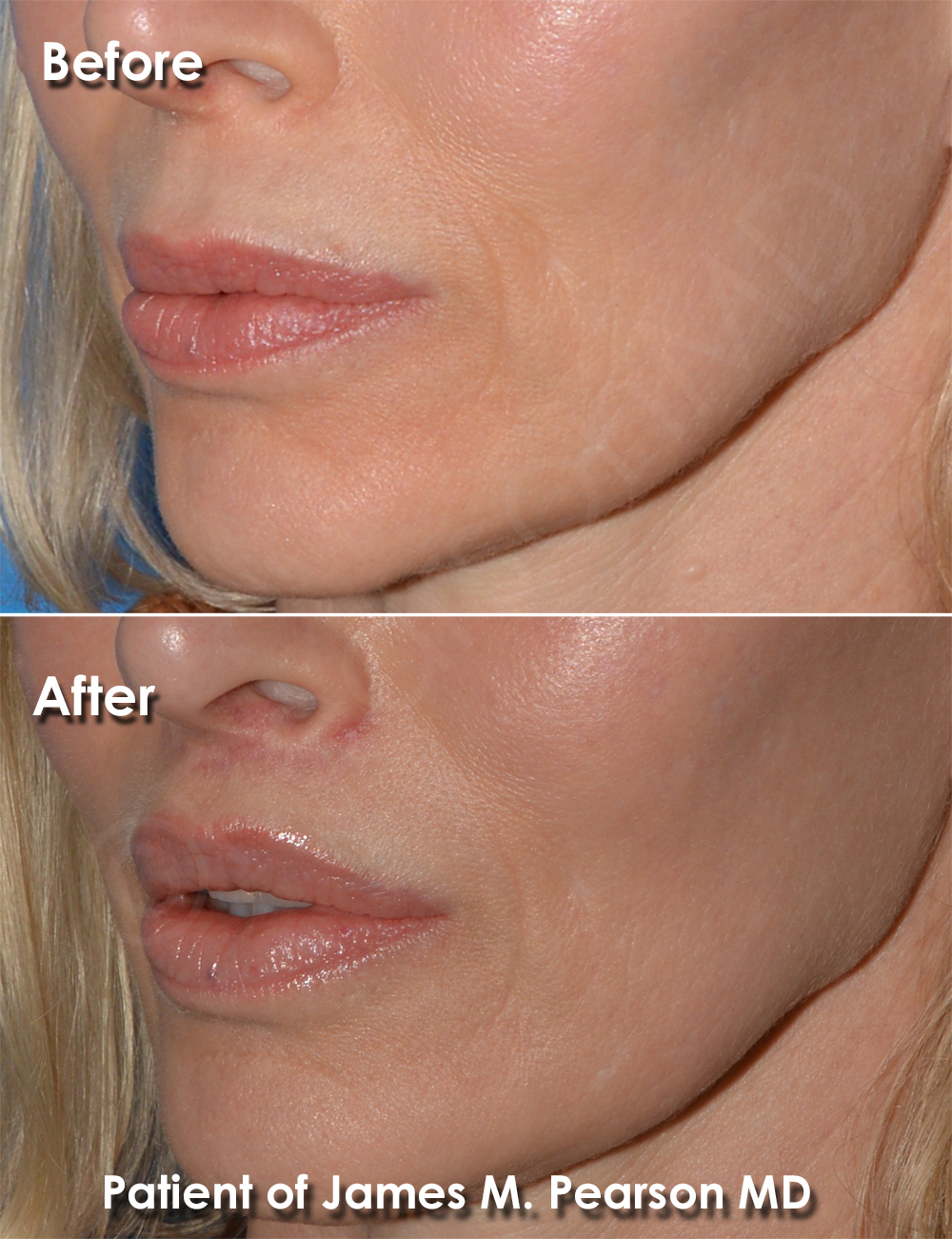 Dr. Pearson Facial Plastic Surgeon