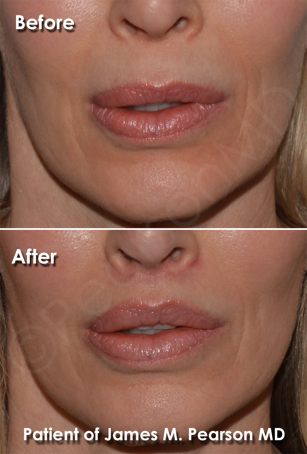 Dr. Pearson Facial Plastic Surgeon
