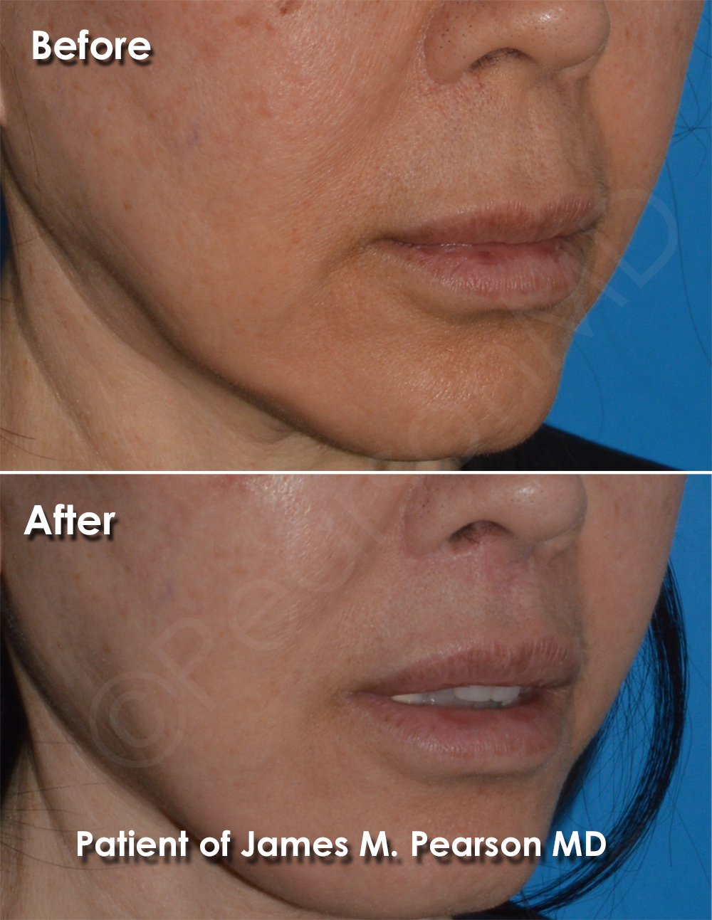 Dr. Pearson Facial Plastic Surgeon