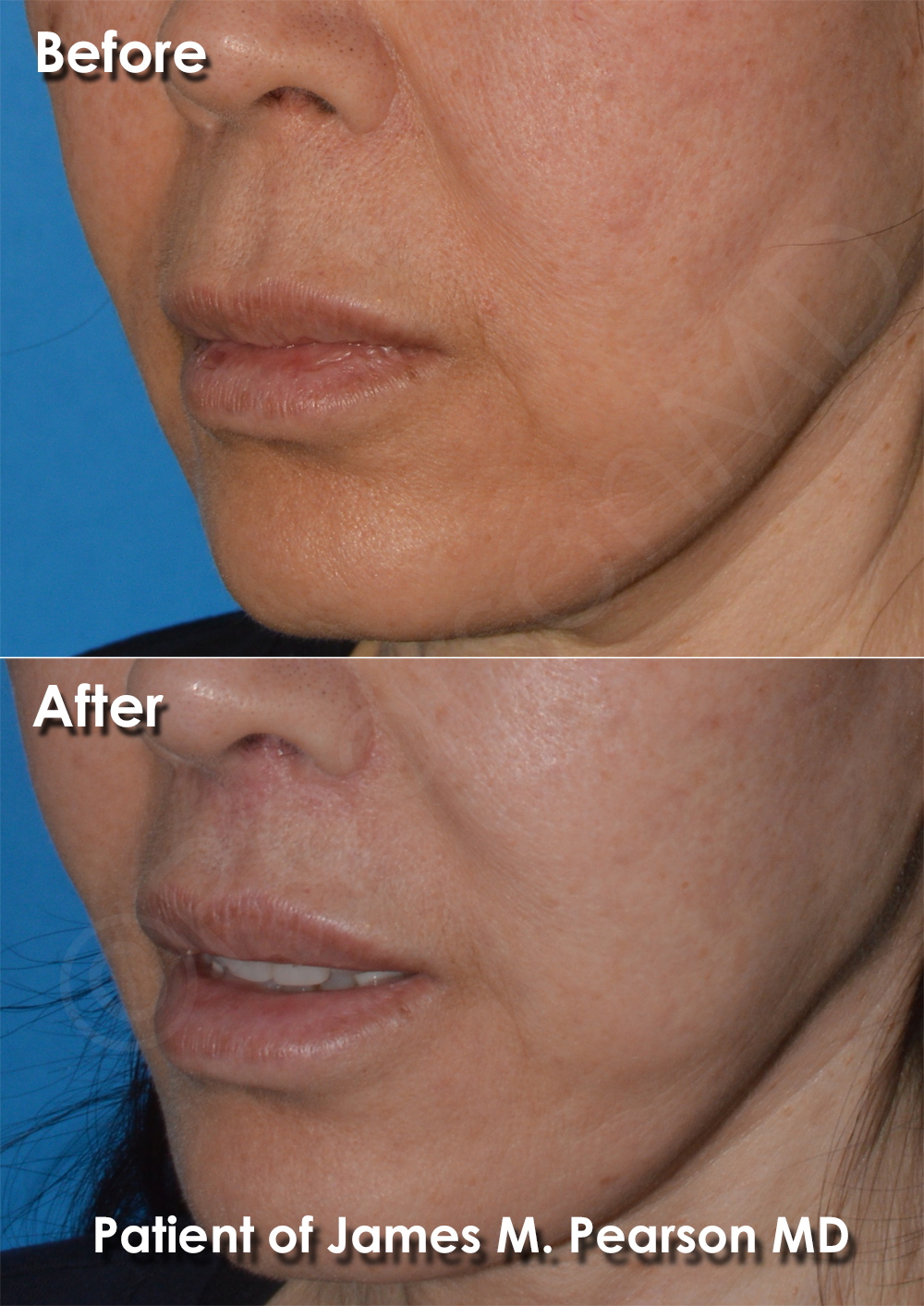 Dr. Pearson Facial Plastic Surgeon