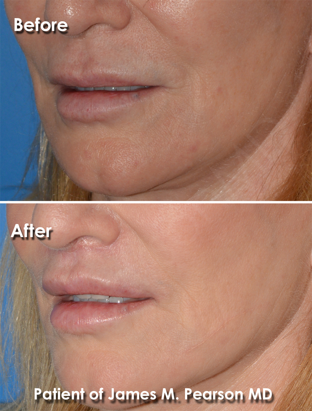 Dr. Pearson Facial Plastic Surgeon