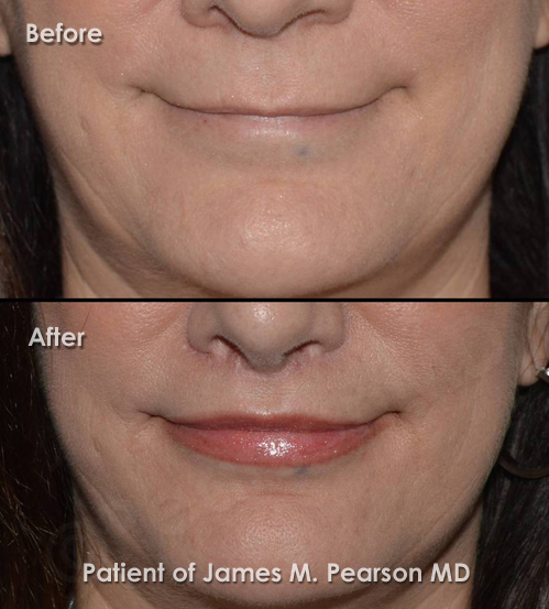 Photo Lip Lift Beverly Hills Beverly Hills Lip Lift Photos