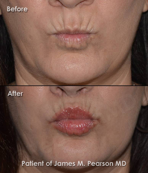 Photo Lip Lift by Dr. James Pearson Facial Plastic Surgery Pearson Lip Lift Photos