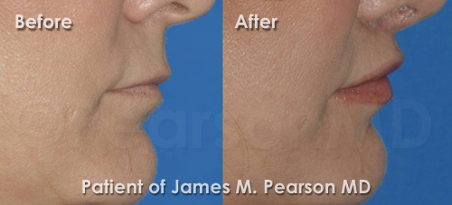 Photo Lip Lift Los Angeles Los Angeles Lip Lift Photos