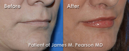 Photo Lip Lift by Dr. James Pearson Facial Plastic Surgery Pearson Lip Enhancement